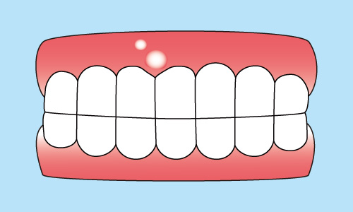 インプラントで歯茎が腫れた場合の理由について