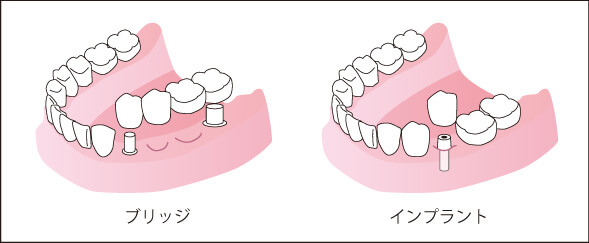 インプラントとブリッジの比較