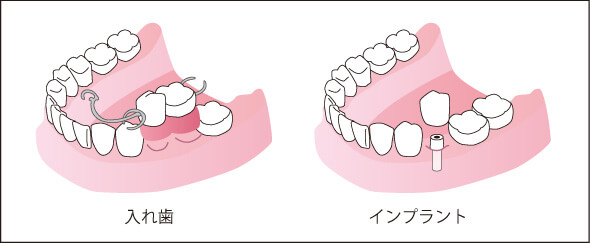 インプラントと入れ歯の比較
