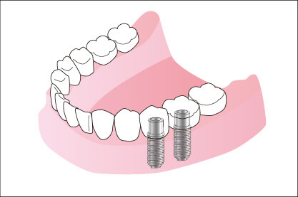インプラントの画像