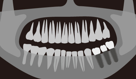 インプラントを入れている人のレントゲン画像