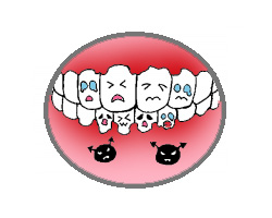 インプラントの細菌感染（イメージ）